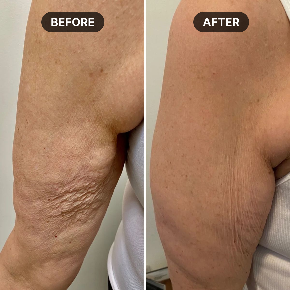 Split-frame before/after photograph of a woman's upper arm, left side showing dry, crepey texture, right side showing sm